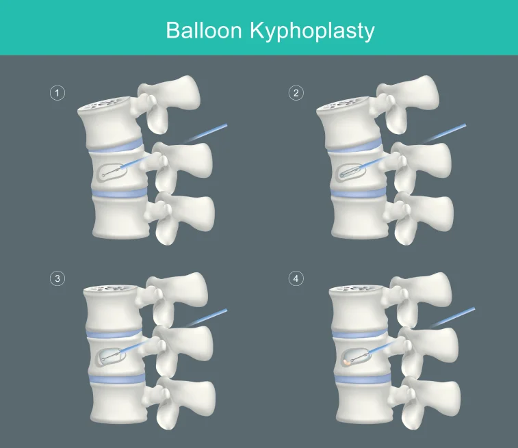 cystectomy
