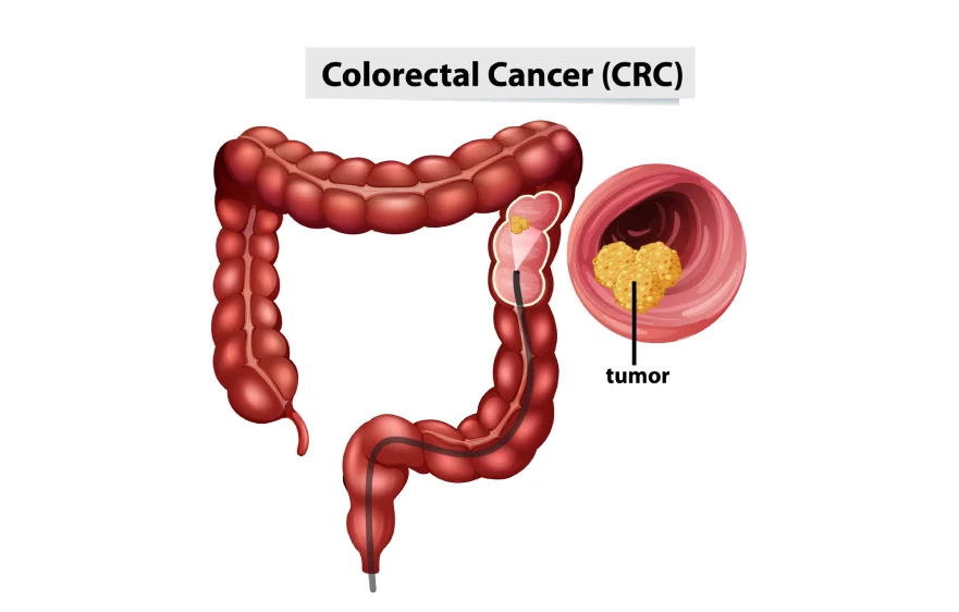 Colonoscopy