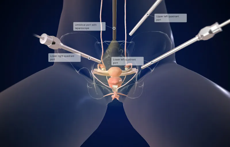 Hysterectomy 