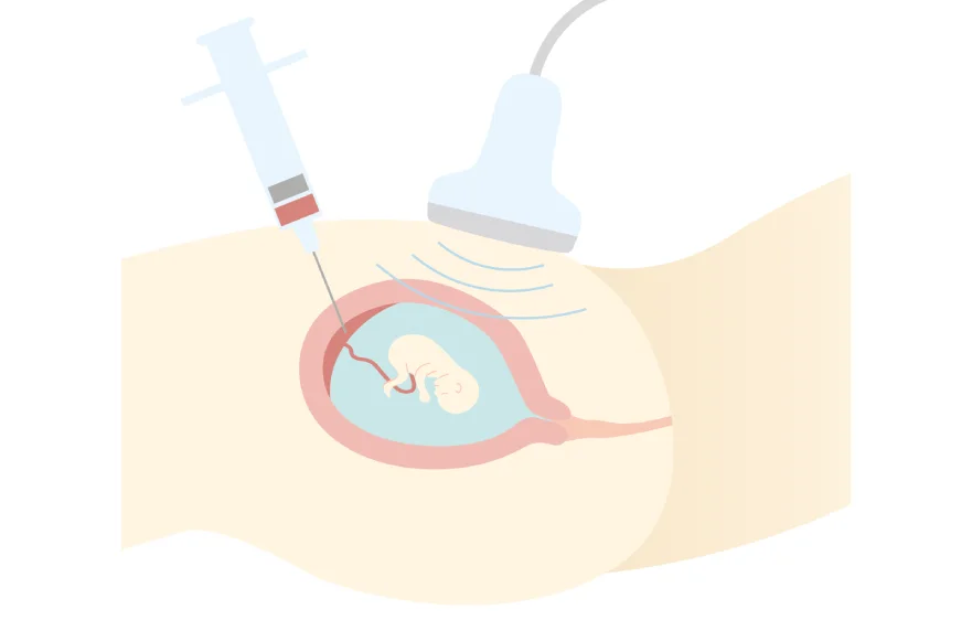 Amniocentesis