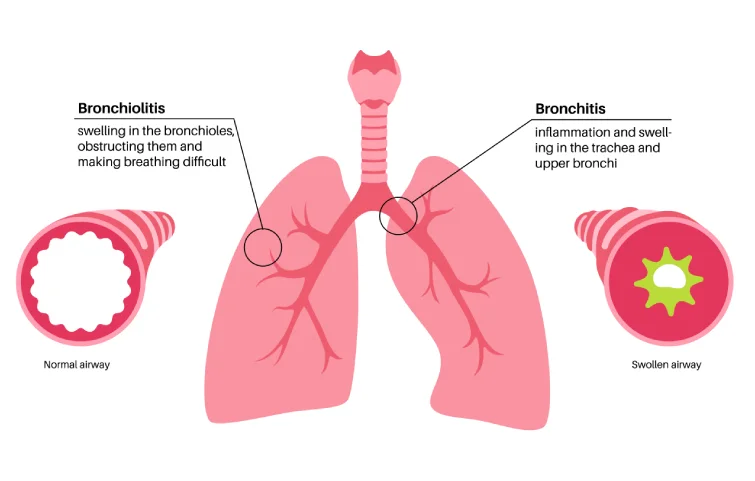 102asi_bronchiolitis-banner.webp