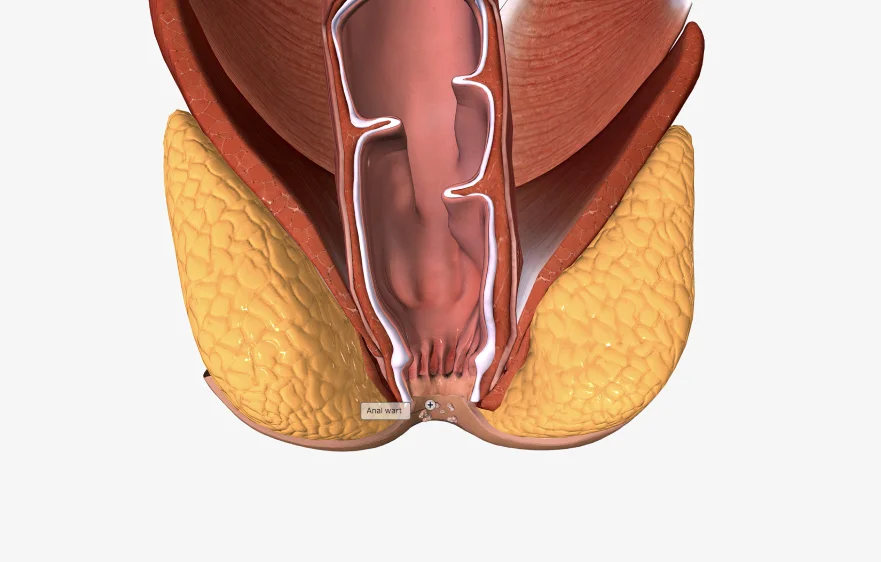 104procs_fissurectomy-overview.webp