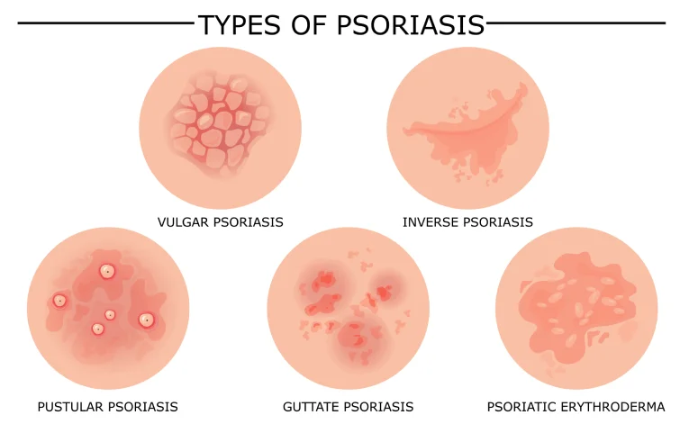 prostatitis-banner5.webp