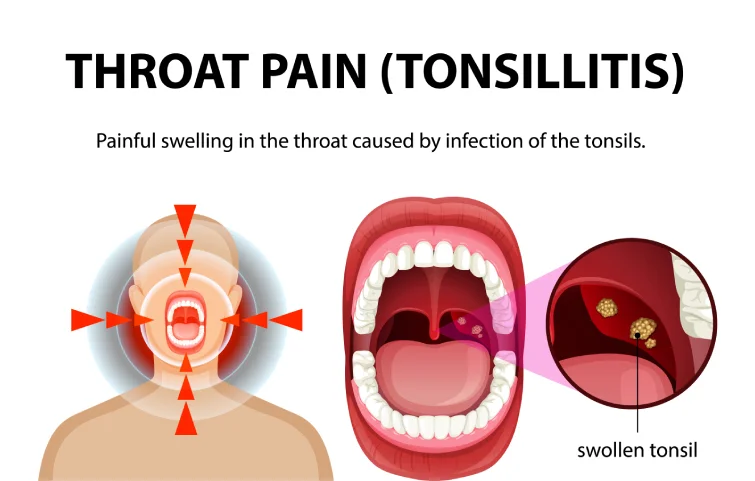 tonsillar-banner.webp