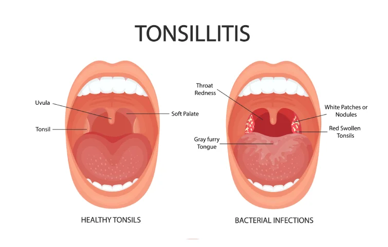 tonsillar-banner3.webp