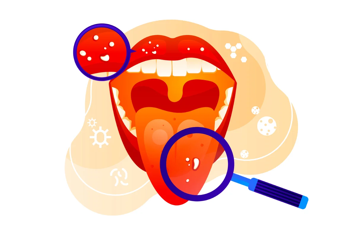 140asi_mouthcancer1.webp