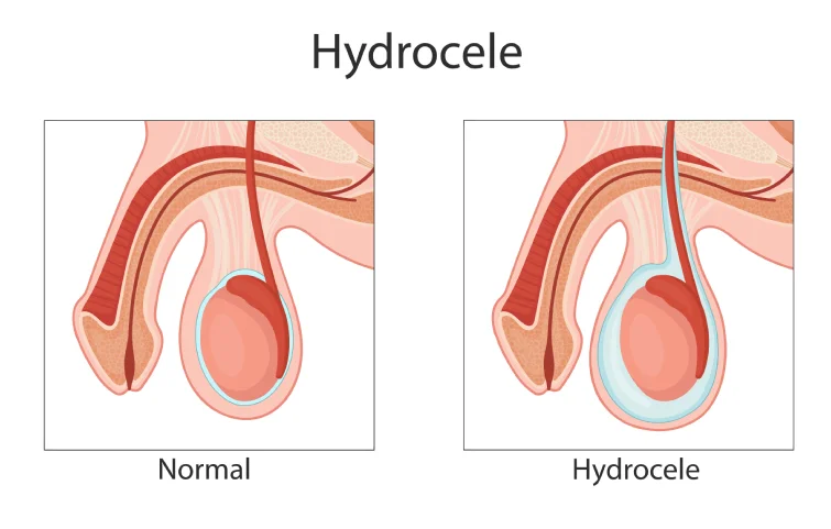 149asi_hydro1.webp