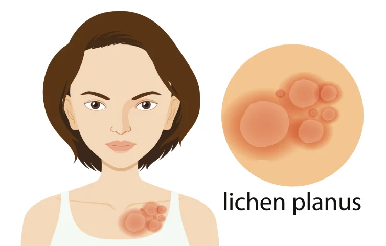 150asi_lichen1.webp