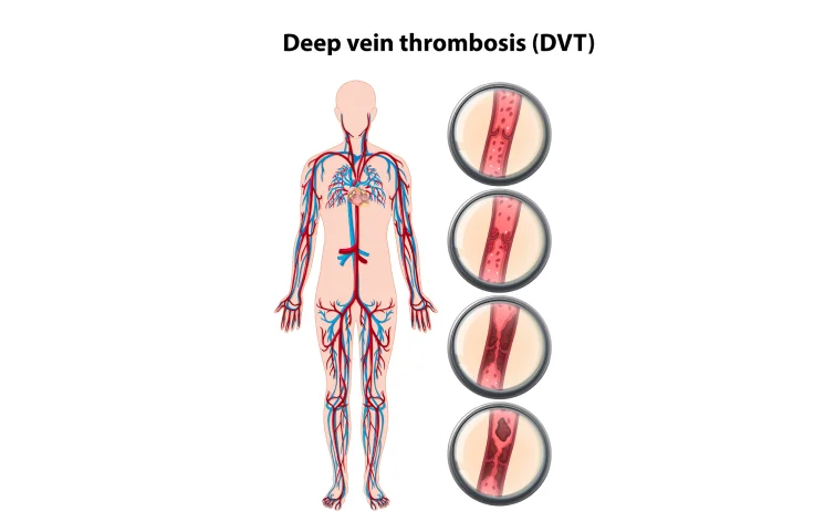 151asi_deep-vein-banner.webp