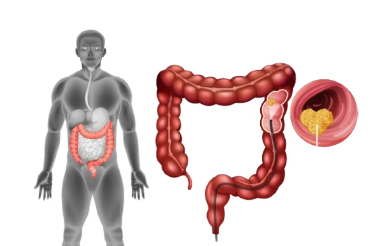 colon-cancer-banner2.webp