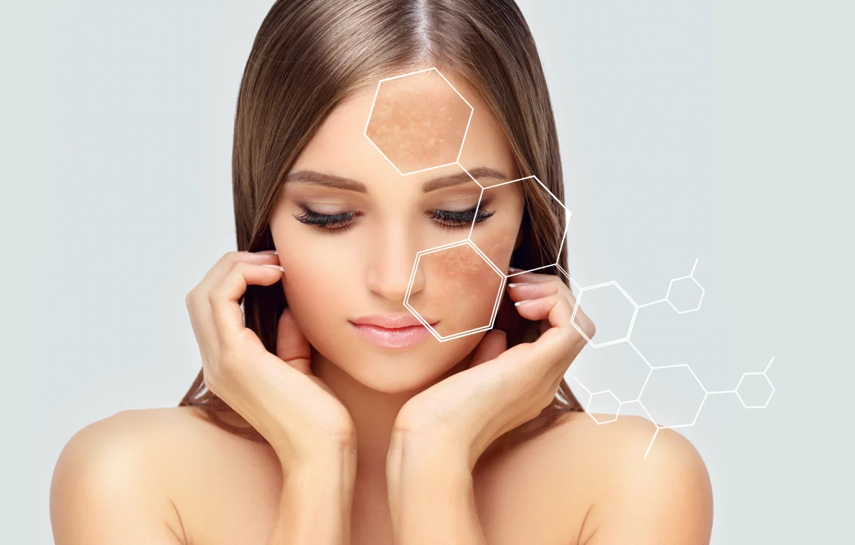 162asi_melasma1.webp