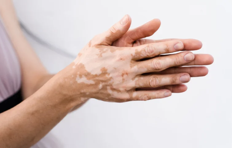 vitiligo-banner2.webp