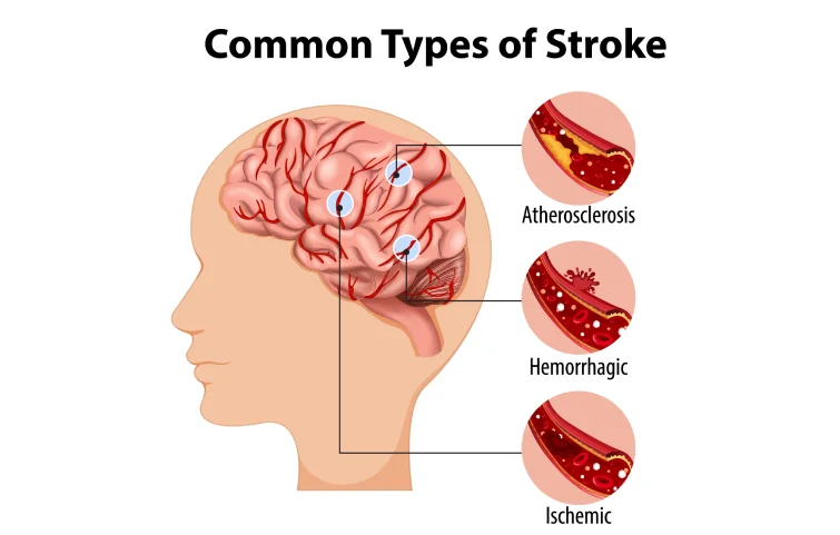 brain-clot-banner3.webp