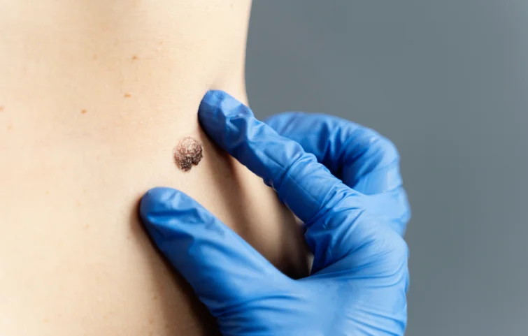 wart-banner.webp