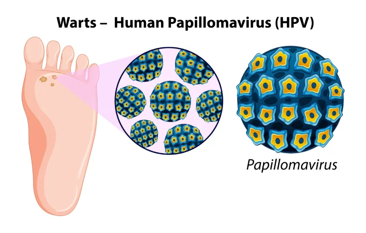 wart-banner3.webp