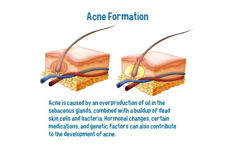 acne-newwbanner.webp