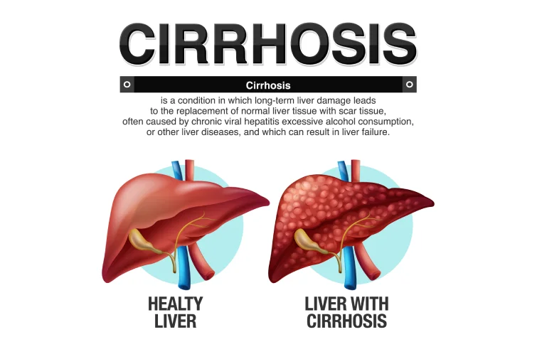 178asi_cirrh1.webp