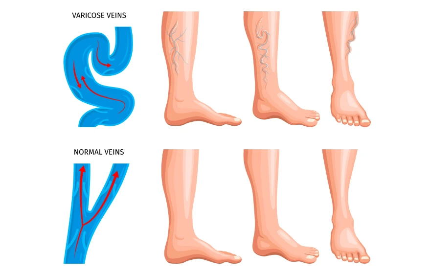 veins.webp