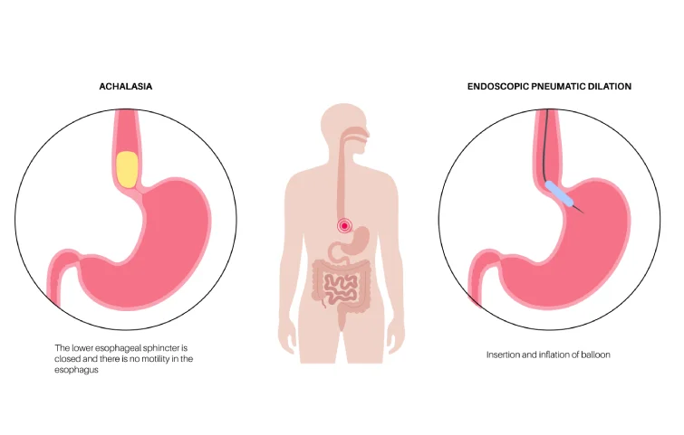 achalasia-banner2.webp
