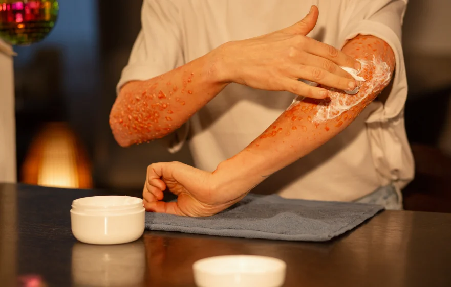atopic-dermatitis.webp