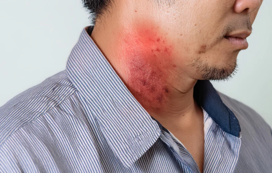 atopic-dermatitis-banner.webp