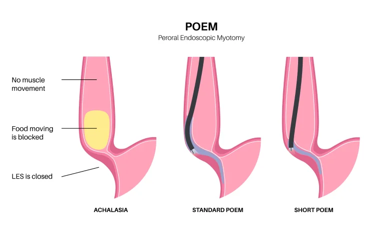 achalasia-banner3.webp