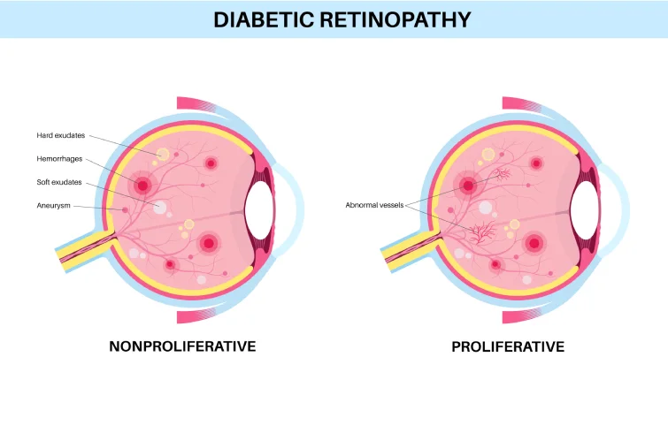 22asi_diabetes-banner.webp