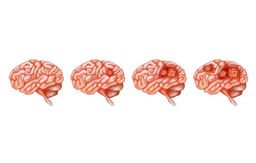 brain-tumor-banner (1).webp