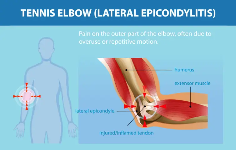 26asi_tennis-elbow-banner.webp