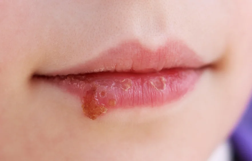 dermatitis-banner (2).webp
