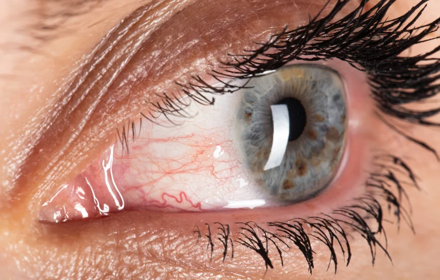 dry-eyes-banner-lumbar.webp