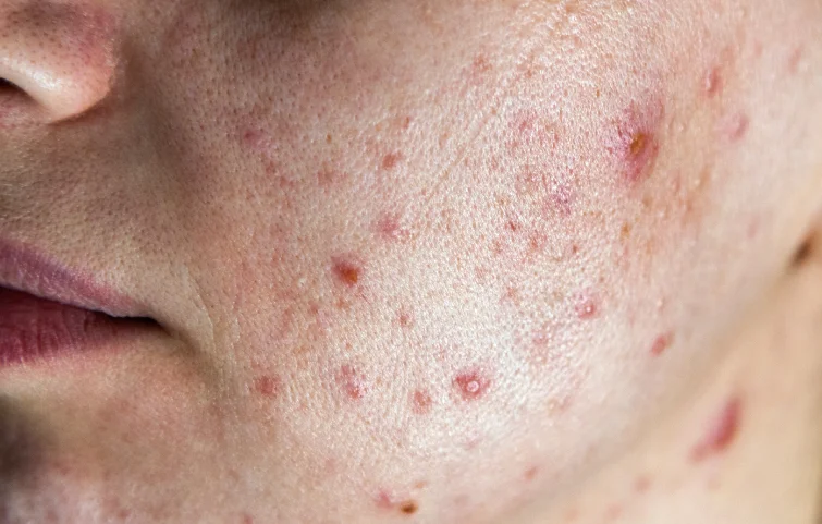 acne-banner6.webp
