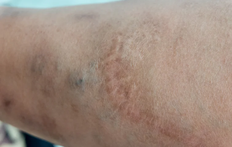 scabies.webp