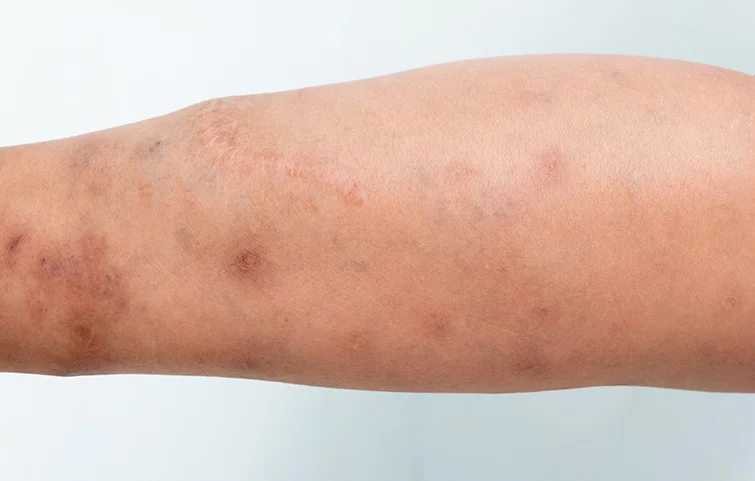 scabies-banners.webp