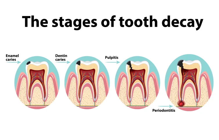2asi_dental-caries-banner.webp