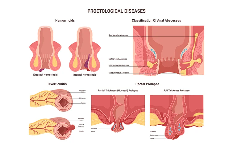 rectal-prolapse-banners.webp