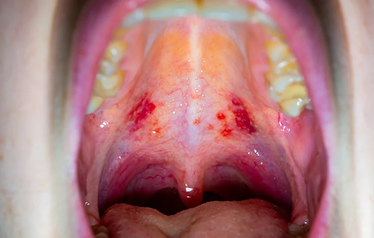 mouthcancer2.webp