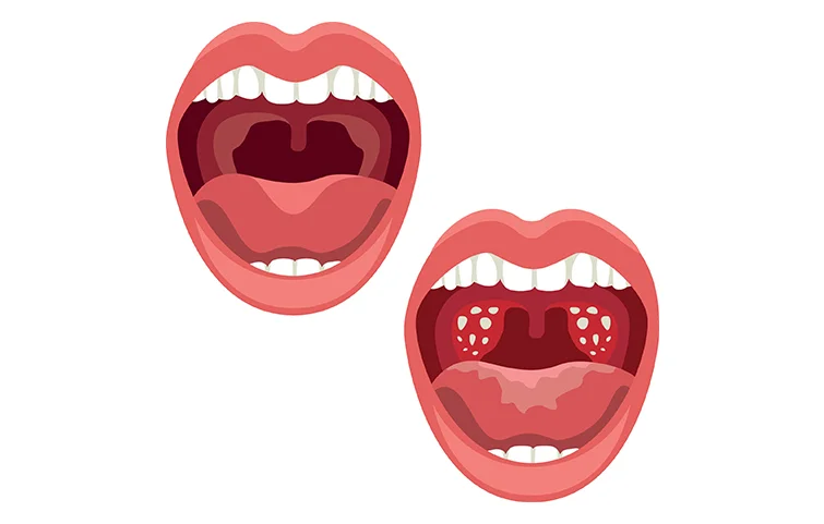 mouthcancer3.webp