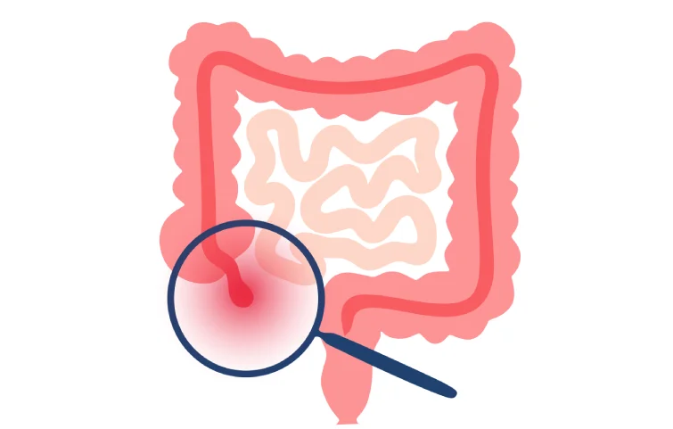 acute-appendicitis-banner6.webp