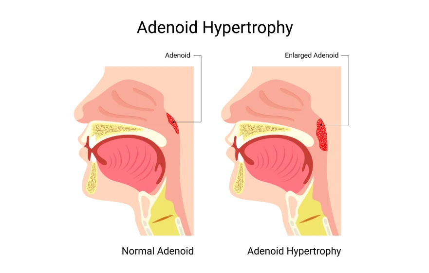 33procs_adenoidectomy-banner.webp