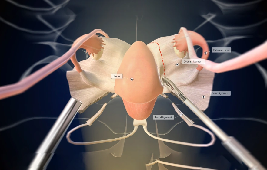 overview-hysterectomy.webp