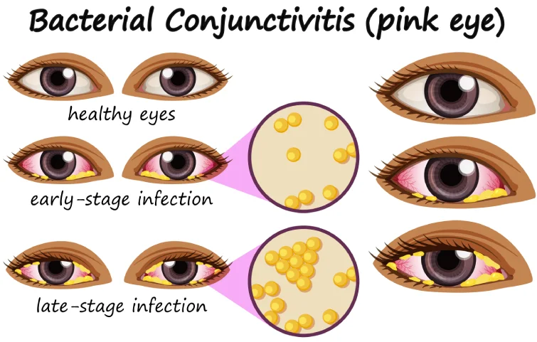 40asi_pink-eye-banner.webp