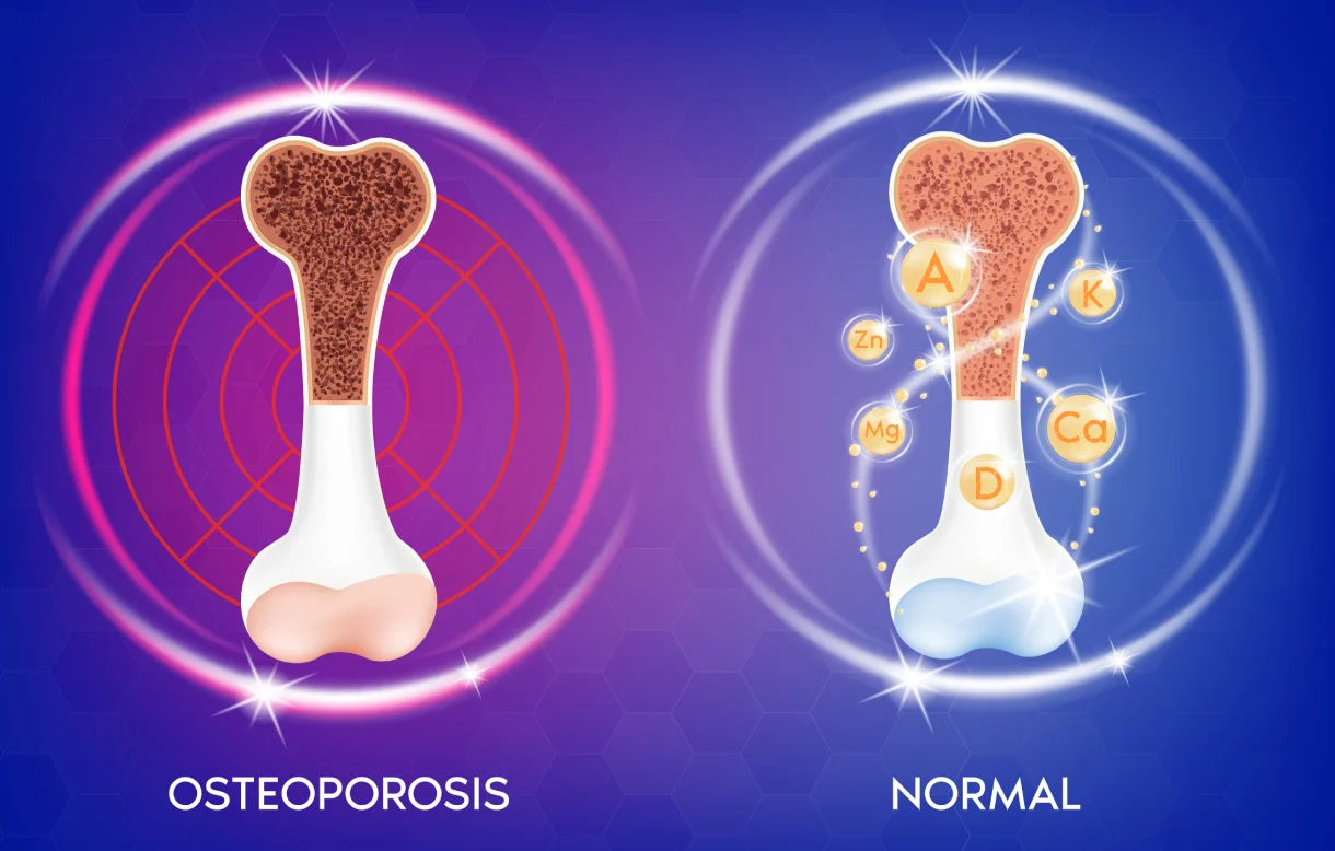 44asi_osteoporosis1.webp
