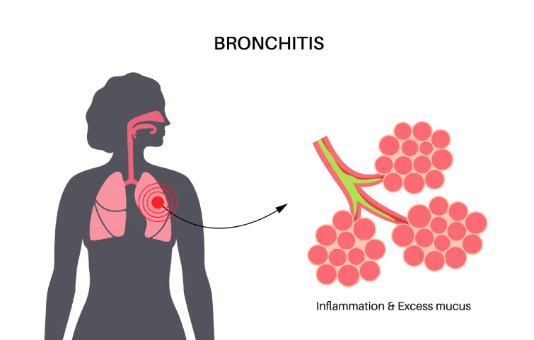 4asi_bronchitis-acute-bronchitis.webp