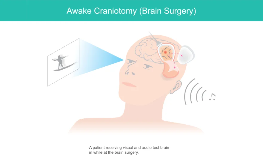 58procs_Craniotomy-overview.webp