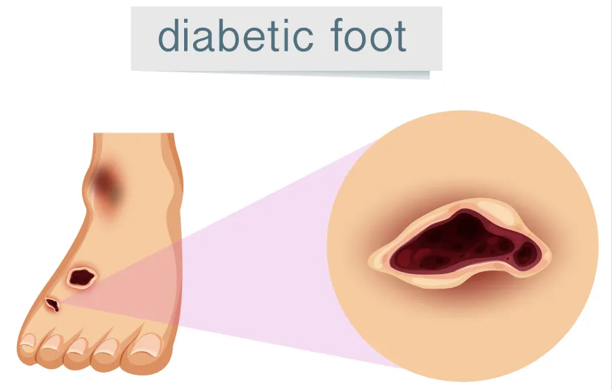 65procs_debridement-one.webp