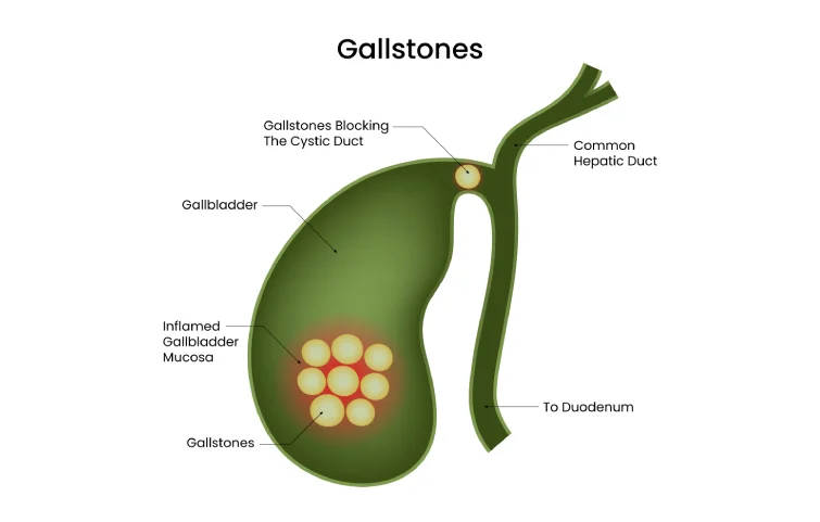 69asi_gallstoemain.webp