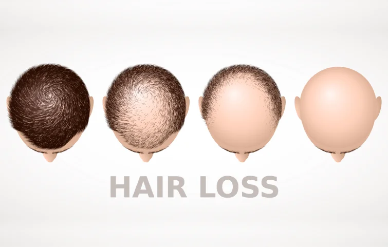 alopecia-banner4.webp