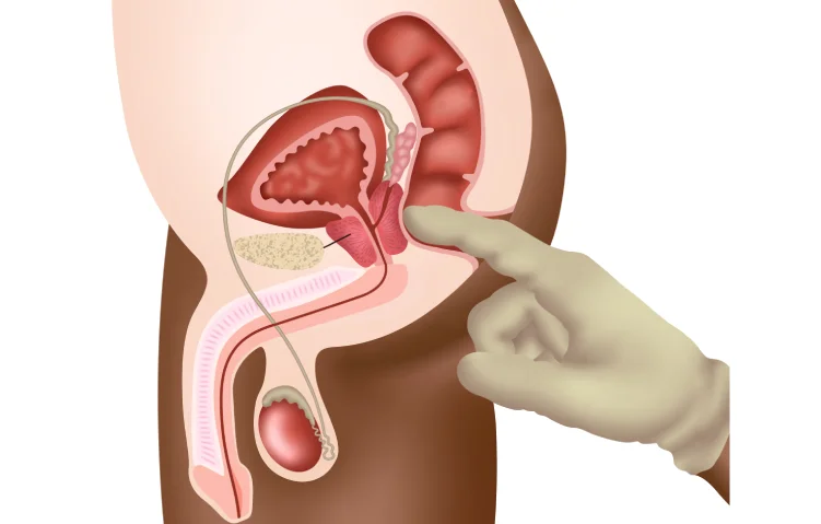 83asi_rectal-prolapse.webp