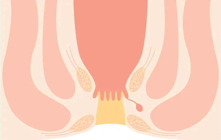 85asi_anal-fissure-banner.webp
